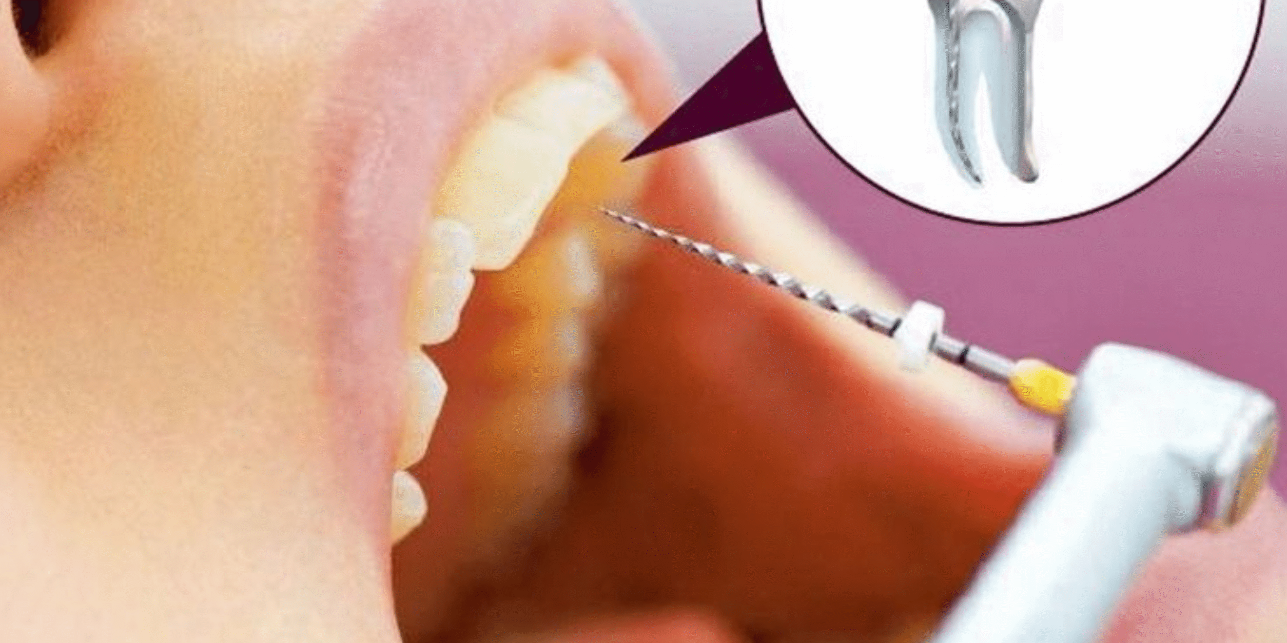 Why Your Tooth Needs a Crown After Root Canal Treatment Root Canal Treatment