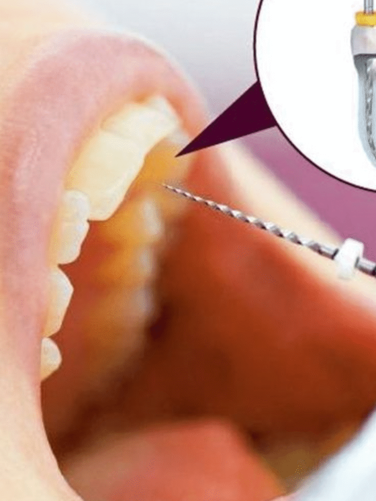 Root Canal Treatment