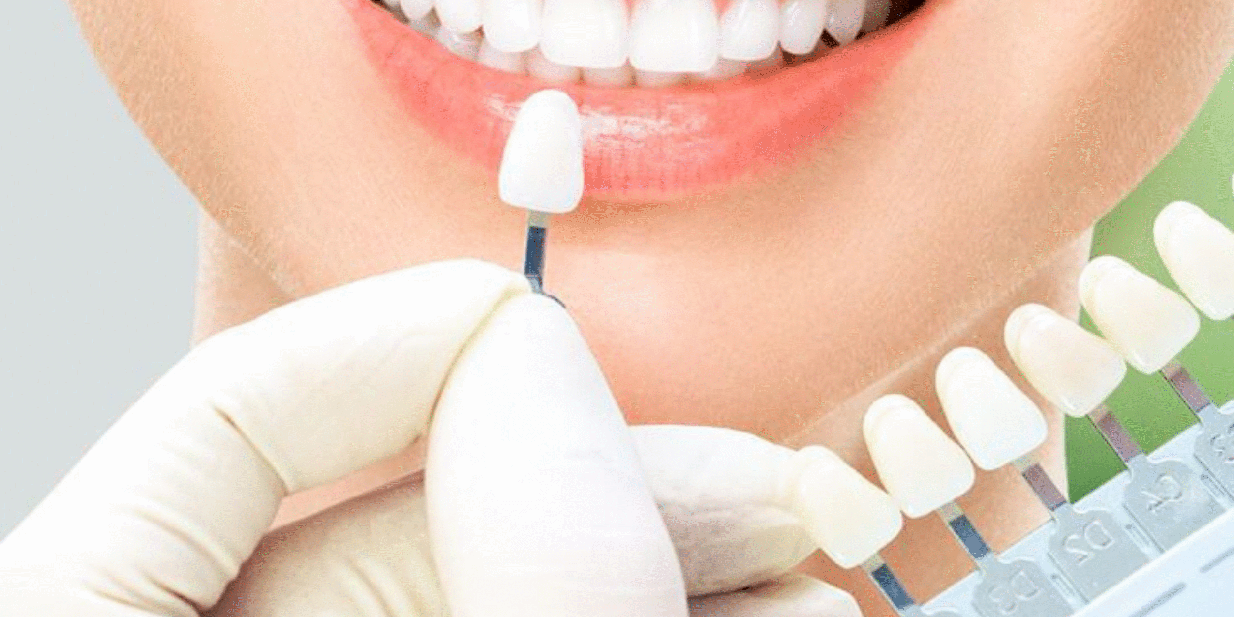 What Are Dental Veneers? A Beginner’s Guide to Understand Dental Veneers dental veneers