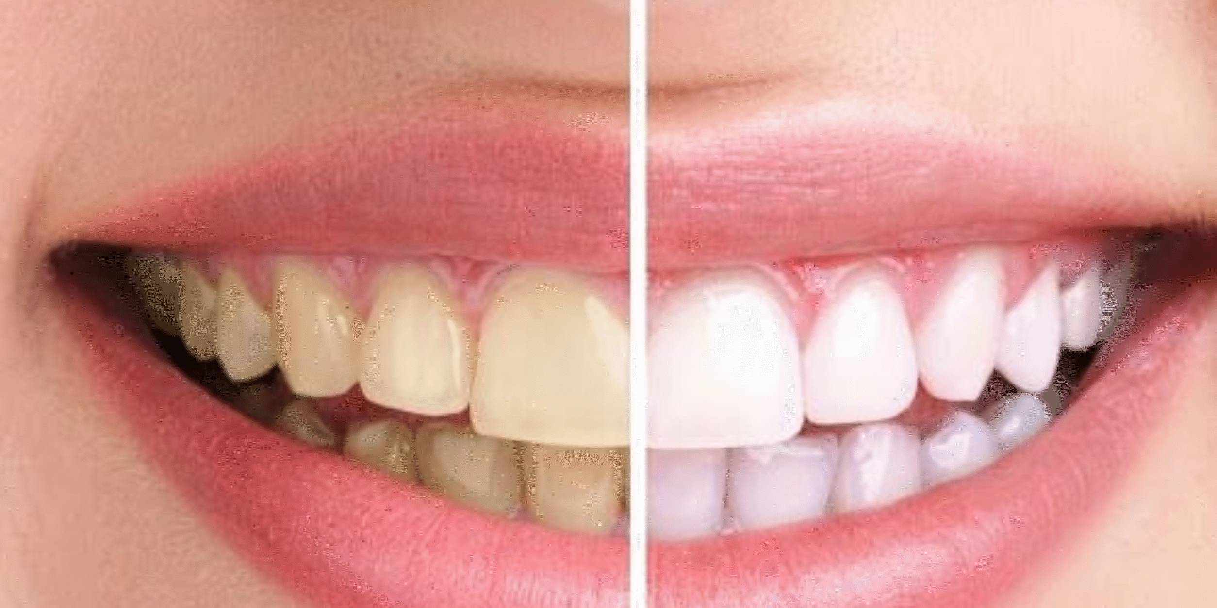 Is Teeth Whitening Safe? Benefits, Risks & Aftercare Guide