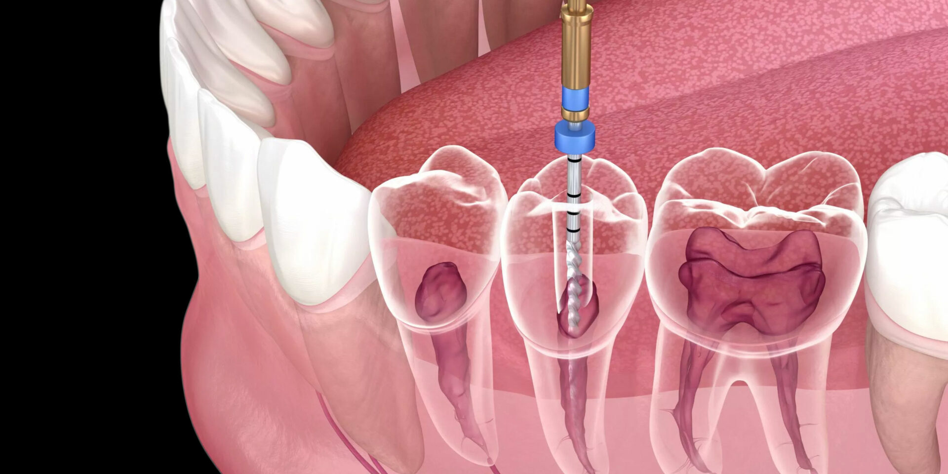 endodontic-