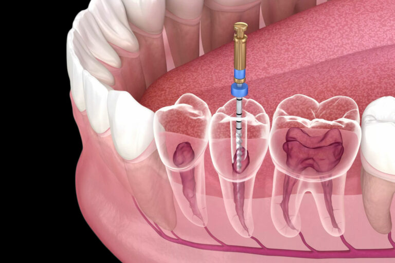 endodontic-
